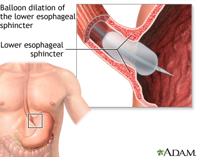 Hie Multimedia Achalasia