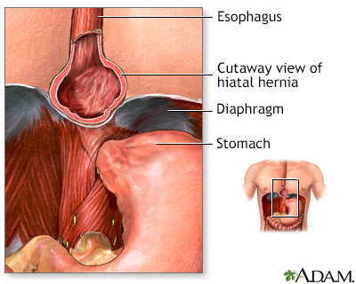 In Depth Reports Gastroesophageal Reflux Disease And Heartburn