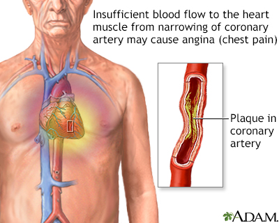 In Depth Reports Coronary Artery Disease