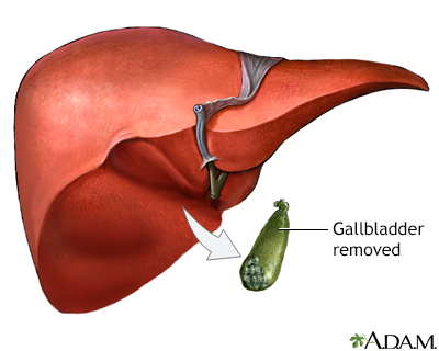 hie multimedia gallbladder removal open